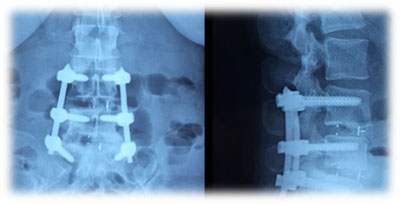 cirugia espinal